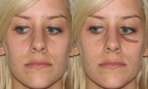 Side-by-side comparison of a person's face showing before and after effects under the eyes with a red line indicating the change.