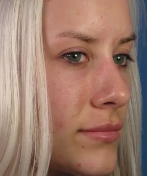 A close-up of a person with long blonde hair, showing a side profile of their face with light makeup and some small blemishes.