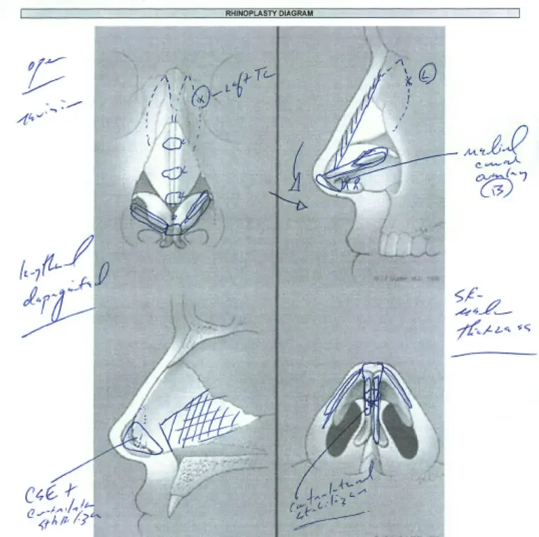 Hand-drawn rhinoplasty diagram with various surgical annotations and illustrations of nasal cross-sections and profiles.