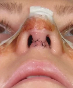 Close-up of a person's nose post-surgery with stitches on the septum and some surrounding bruising and redness.