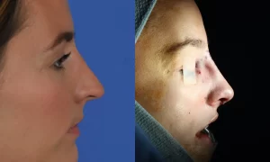 Side-by-side image showing a person's profile before and after undergoing nose surgery. The right side shows bandages on the nose.