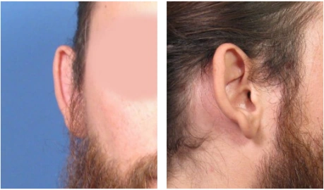 Two side-by-side images of a person's ear showing before and after views of a surgical procedure to reduce the ear's prominence.