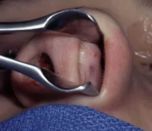 A close-up of a nostril being examined with a nasal speculum, revealing the nasal cavity.