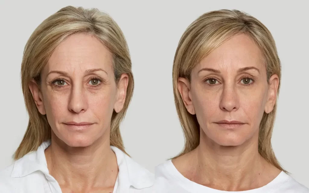 Two side-by-side images of a person with blonde hair wearing a white shirt, showing a difference in skin smoothness and reduced under-eye circles.