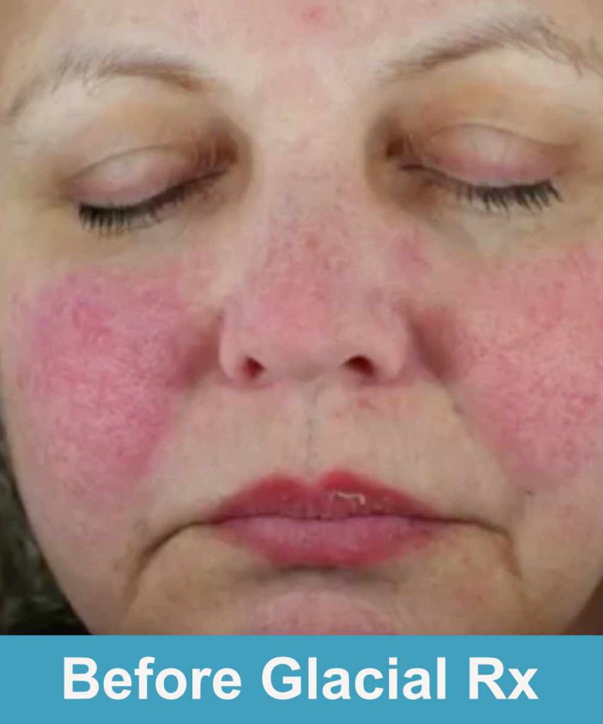 Close-up of a person's face with eyes closed and red, irritated skin on the cheeks and nose, before a Glacial Rx treatment.