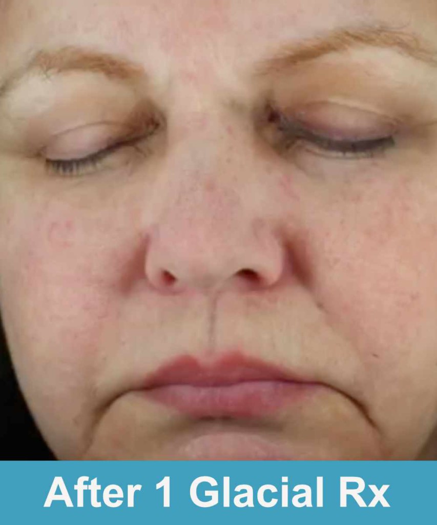 Close-up of a person's face with closed eyes, showing skin texture and redness. Text at the bottom reads, "After 1 Glacial Rx.