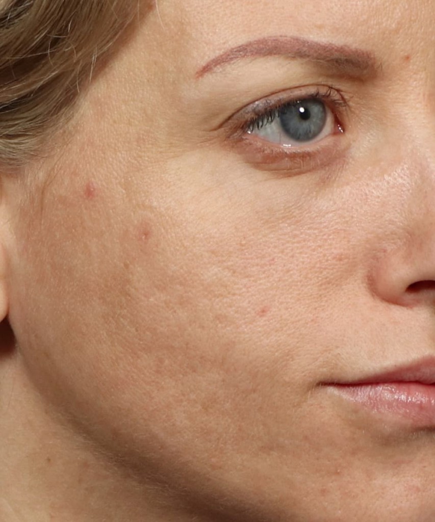 Close-up of a person's face showing skin texture and pores on the cheek.