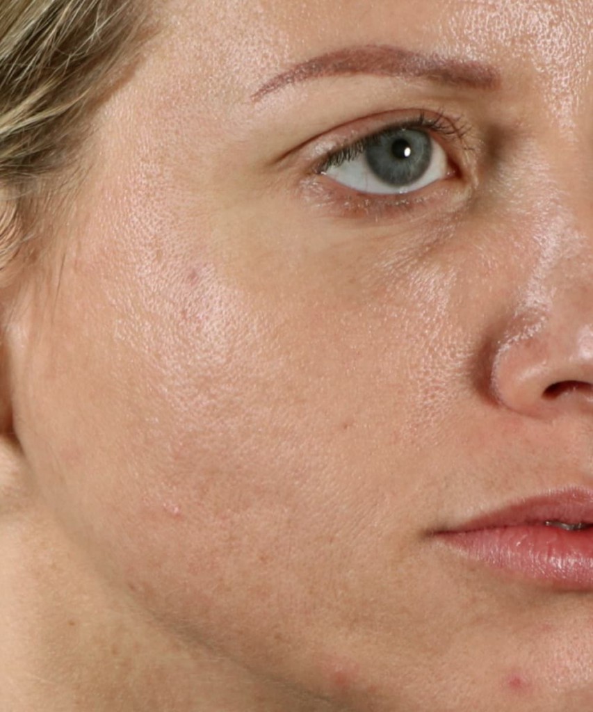 Close-up of a person's face showing visible skin texture with pores and blemishes.