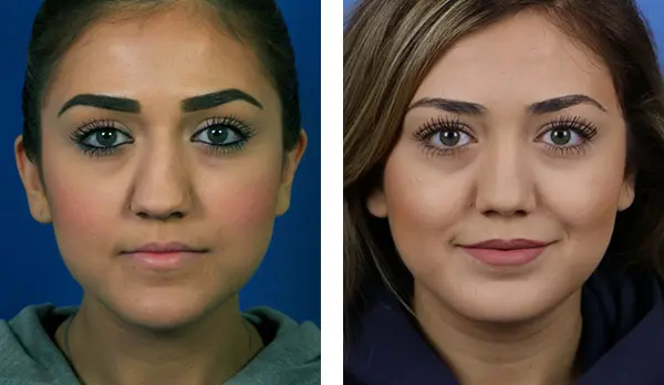 Two side-by-side portraits of a woman against a blue background, before and after a cosmetic procedure.